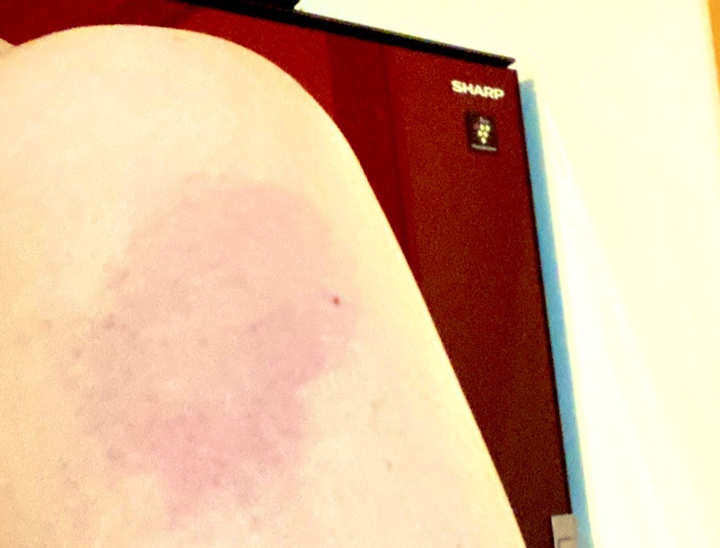 モデルアームと言われる症状なのか、腕が赤く腫れて痒くなりました!